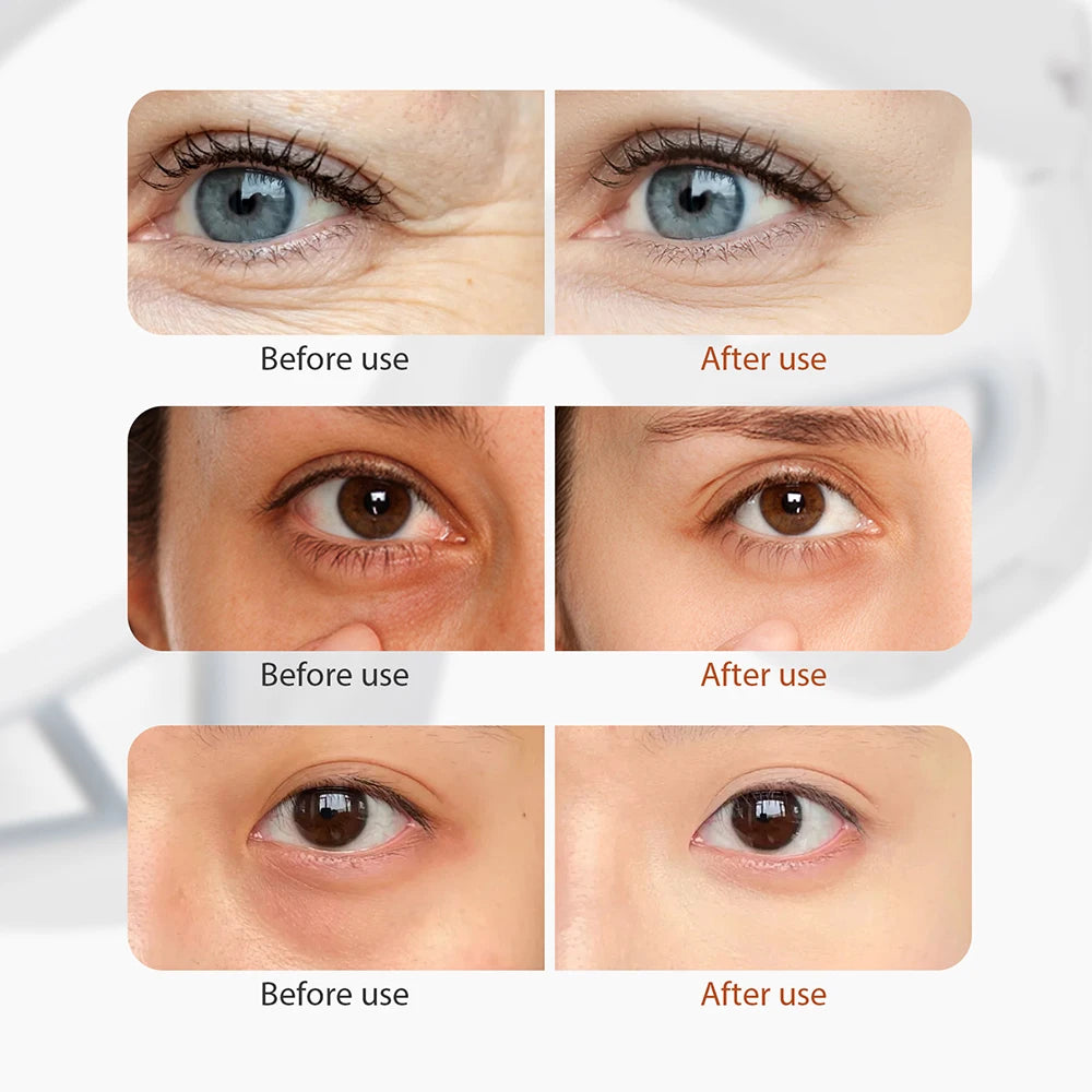 Eyes Beauty Device Removal Dark Circles - GlowLiftEssentials.shop